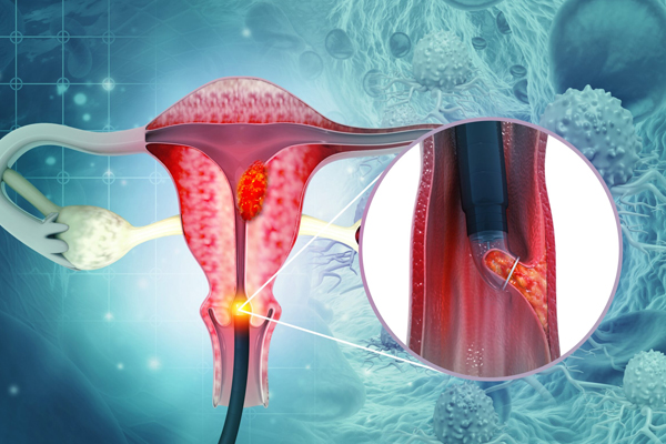 Cervical Screening & Colposcopy